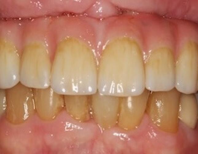 Whitening before