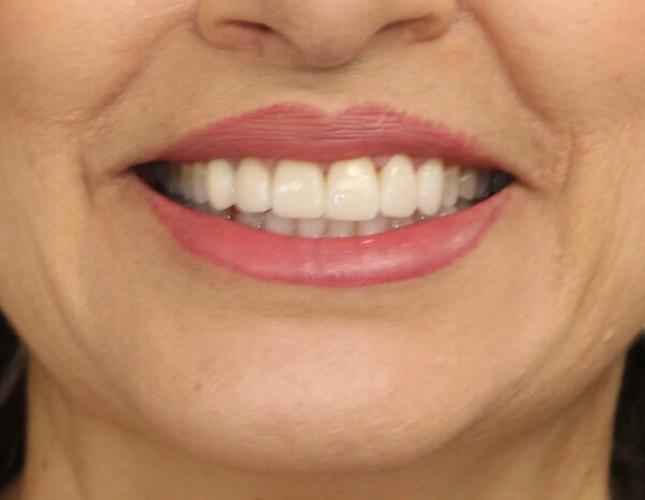 Crown lengthening after