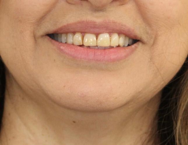 Crown lengthening before