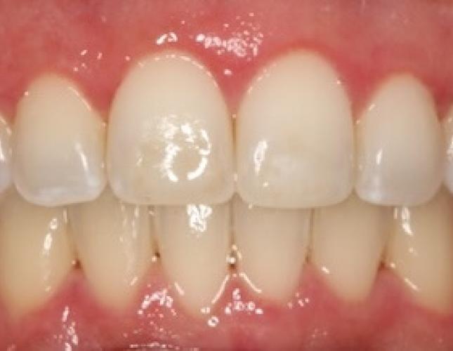 Crown lengthening after