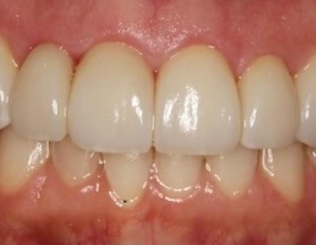 Veneers after