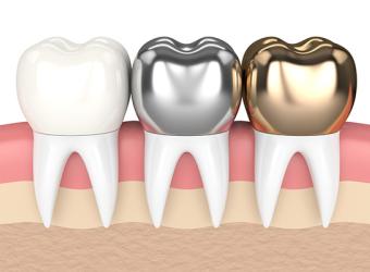 Crowns &amp; Bridgework
